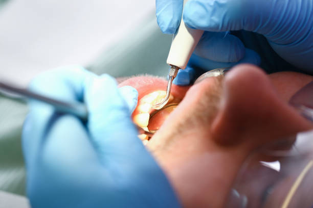 Best Knocked-Out Tooth (Avulsed Tooth) Treatment in Black Canyon City, AZ